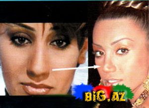 Şou-biznesimizin plastik əməliyyat keçirən simaları